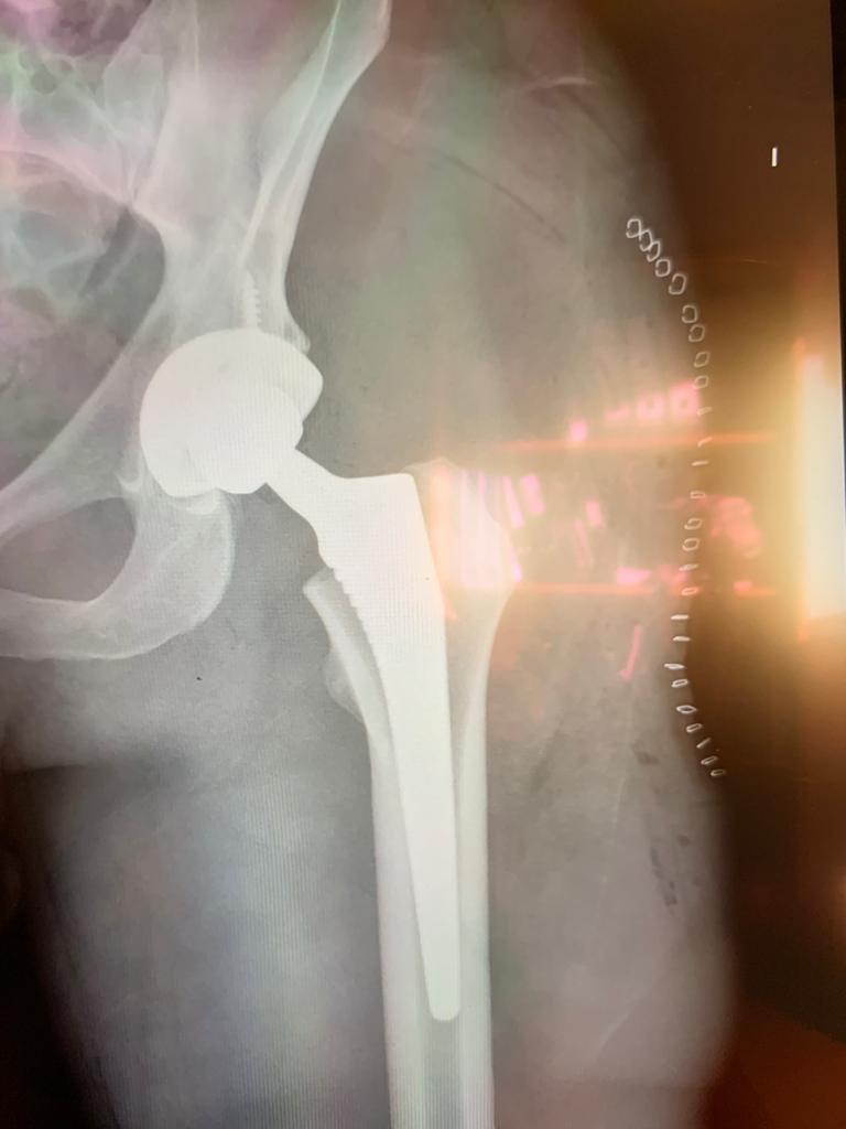 A total hip replacement after a cycle crash in Spain